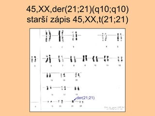 45,XX,der(21;21)(q10;q10) star? zpis 45,XX,t(21;21) der(21;21) 