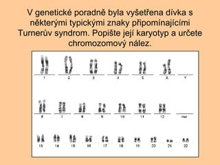 V genetick poradn byla vy?et?ena dvka s nkter?mi typick?mi znaky p?ipomnajcmi Turner?v syndrom. Popi?te jej karyotyp a ur?ete chromozomov? nlez. 