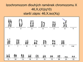 Izochromozom dlouh?ch ramnek chromozomu X 46,X,i(X)(q10) star? zpis: 46,X,iso(Xq) 