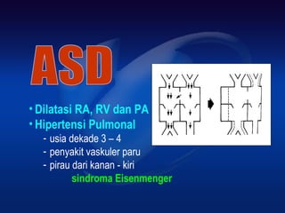 • Dilatasi RA, RV dan PA
• Hipertensi Pulmonal
­ usia dekade 3 – 4
­ penyakit vaskuler paru
­ pirau dari kanan ­ kiri
sindroma Eisenmenger
 