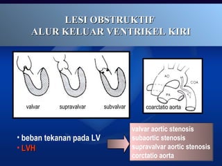 valvar aortic stenosis
subaortic stenosis
supravalvar aortic stenosis
corctatio aorta
valvar aortic stenosis
subaortic stenosis
supravalvar aortic stenosis
corctatio aorta
LESI OBSTRUKTIFLESI OBSTRUKTIF
ALUR KELUAR VENTRIKEL KIRIALUR KELUAR VENTRIKEL KIRI
valvar supravalvar subvalvar coarctatio aorta
• beban tekanan pada LV
• LVHLVH
 
