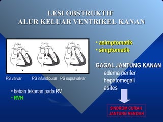 LESI OBSTRUKTIFLESI OBSTRUKTIF
ALUR KELUAR VENTRIKEL KANANALUR KELUAR VENTRIKEL KANAN
PS valvar PS infundibular PS supravalvar
• beban tekanan pada RV
• RVHRVH
• asimptomatikasimptomatik
• simptomatiksimptomatik
GAGAL JANTUNG KANANGAGAL JANTUNG KANAN
edema perifer
hepatomegali
asites
SINDROM CURAHSINDROM CURAH
JANTUNG RENDAHJANTUNG RENDAH
 