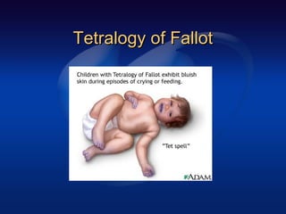 Tetralogy of FallotTetralogy of Fallot
 