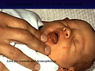 Look for cyanosis and dysmorphology
Examination of CVS in the newborn
 