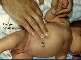 Feel for
hepatomegally
 
