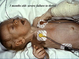 3 months old- severe failure to thrive
 