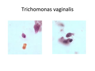 Trichomonas vaginalis
 