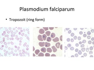 Plasmodium falciparum
• Tropozoit (ring form)
 
