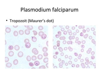 Plasmodium falciparum
• Tropozoit (Maurer’s dot)
 