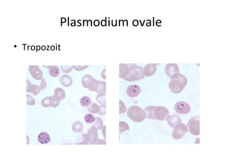 Plasmodium ovale
• Tropozoit
 