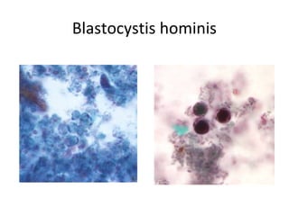 Blastocystis hominis
 