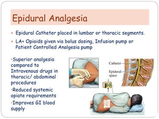 Epidural Analgesia
 Epidural Catheter placed in lumbar or thoracic segments.
 LA+ Opioids given via bolus dosing, Infusion pump or
Patient Controlled Analgesia pump
•Superior analgesia
compared to
Intravenous drugs in
thoracic/ abdominal
procedures
•Reduced systemic
opiate requirements
•Improves GI blood
supply
 