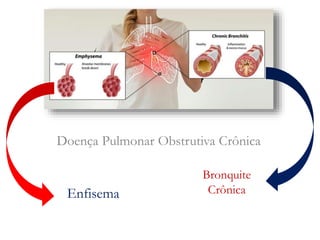 Enfisema
Bronquite
Crônica
Doença Pulmonar Obstrutiva Crônica
 