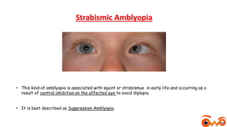 OWP Amblyopia.pptx