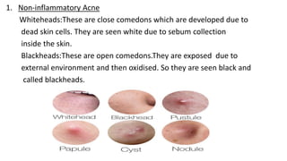1. Non-inflammatory Acne
Whiteheads:These are close comedons which are developed due to
dead skin cells. They are seen white due to sebum collection
inside the skin.
Blackheads:These are open comedons.They are exposed due to
external environment and then oxidised. So they are seen black and
called blackheads.
 