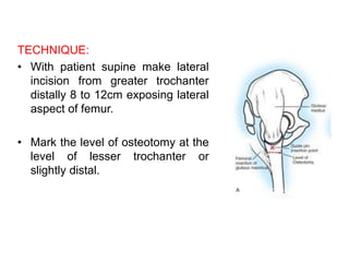 osteotomies around hip | PPTX