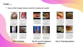 Vitamin Deficiency Detection Using Image Processing and Neural Network ...