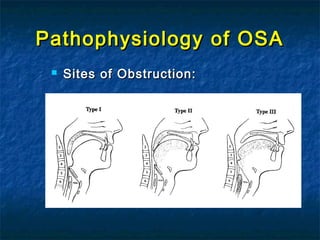 Pathophysiology of OSAPathophysiology of OSA
 Sites of Obstruction:Sites of Obstruction:
 