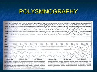 POLYSMNOGRAPHYPOLYSMNOGRAPHY
 