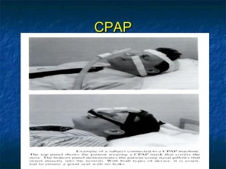 CPAPCPAP
 