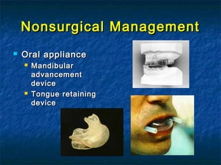Nonsurgical ManagementNonsurgical Management
 Oral applianceOral appliance
 MandibularMandibular
advancementadvancement
devicedevice
 Tongue retainingTongue retaining
devicedevice
 