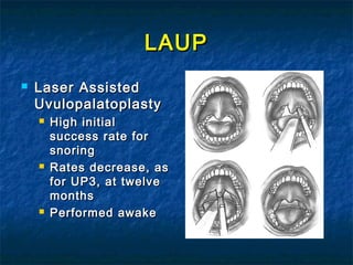 LAUPLAUP
 Laser AssistedLaser Assisted
UvulopalatoplastyUvulopalatoplasty
 High initialHigh initial
success rate forsuccess rate for
snoringsnoring
 Rates decrease, asRates decrease, as
for UP3, at twelvefor UP3, at twelve
monthsmonths
 Performed awakePerformed awake
 