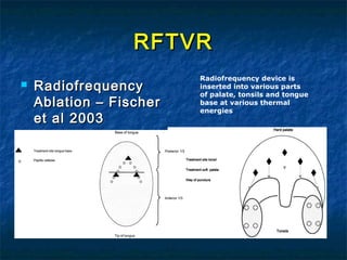 RFTVRRFTVR
 RadiofrequencyRadiofrequency
Ablation – FischerAblation – Fischer
et al 2003et al 2003
Radiofrequency device is
inserted into various parts
of palate, tonsils and tongue
base at various thermal
energies
 