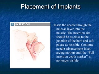 Placement of ImplantsPlacement of Implants
Insert the needle through the
mucosa layer into the
muscle. The insertion site
should be as close to the
junction of the hard and soft
palate as possible. Continue
needle advancement in an
arcing motion until the “Full
insertion depth marker” is
no longer visible.
Insertion point
 