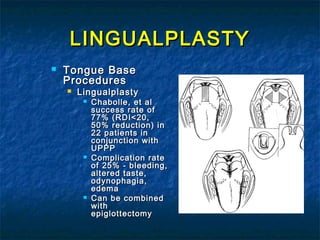 LINGUALPLASTYLINGUALPLASTY
 Tongue BaseTongue Base
ProceduresProcedures
 LingualplastyLingualplasty
 Chabolle, et alChabolle, et al
success rate ofsuccess rate of
77% (RDI<20,77% (RDI<20,
50% reduction) in50% reduction) in
22 patients in22 patients in
conjunction withconjunction with
UPPPUPPP
 Complication rateComplication rate
of 25% - bleeding,of 25% - bleeding,
altered taste,altered taste,
odynophagia,odynophagia,
edemaedema
 Can be combinedCan be combined
withwith
epiglottectomyepiglottectomy
 