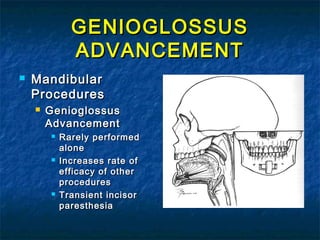 GENIOGLOSSUSGENIOGLOSSUS
ADVANCEMENTADVANCEMENT
 MandibularMandibular
ProceduresProcedures
 GenioglossusGenioglossus
AdvancementAdvancement
 Rarely performedRarely performed
alonealone
 Increases rate ofIncreases rate of
efficacy of otherefficacy of other
proceduresprocedures
 Transient incisorTransient incisor
paresthesiaparesthesia
 