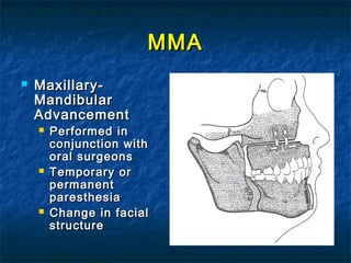 MMAMMA
 Maxillary-Maxillary-
MandibularMandibular
AdvancementAdvancement
 Performed inPerformed in
conjunction withconjunction with
oral surgeonsoral surgeons
 Temporary orTemporary or
permanentpermanent
paresthesiaparesthesia
 Change in facialChange in facial
structurestructure
 