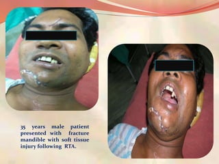 35 years male patient
presented with fracture
mandible with soft tissue
injury following RTA.
 