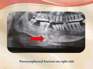 Parasymphyseal fracture on right side.
 