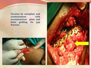 Fixation by miniplate and
reinforcement with
reconstruction plate and
bone grafting for gap
fracture.
 