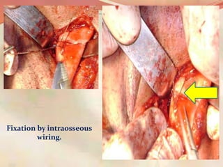 Fixation by intraosseous
wiring.
 