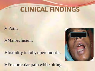  Pain.
Malocclusion.
Inability to fully open mouth.
Preauricular pain while biting.
 