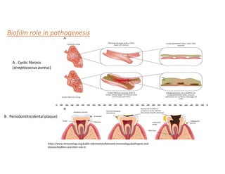 Biofilm role in pathogenesis
A . Cystic fibrosis
(streptococcus aureus)
B . Periodontitis(dental plaque)
https://www.immunology.org/public-information/bitesized-immunology/pathogens-and-
disease/biofilms-and-their-role-in
 
