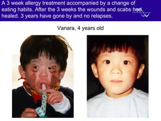 A 3 week allergy treatment accompanied by a change of
eating habits. After the 3 weeks the wounds and scabs had
healed. 3 years have gone by and no relapses.
Vanara, 4 years old
 