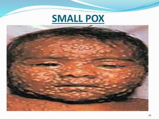 SMALL POX
22
 