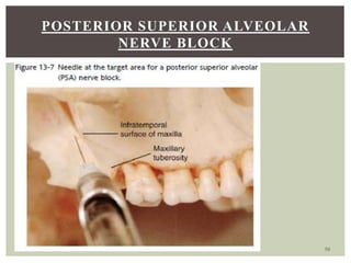 Local anaesthesia - Basics in dentistry | PPTX