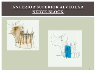 Local anaesthesia - Basics in dentistry | PPTX