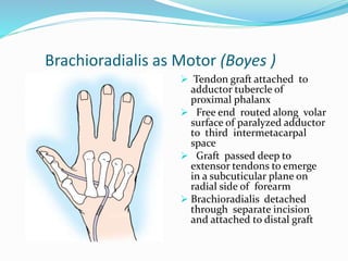 Brachioradialis as Motor (Boyes )
 Tendon graft attached to
adductor tubercle of
proximal phalanx
 Free end routed along volar
surface of paralyzed adductor
to third intermetacarpal
space
 Graft passed deep to
extensor tendons to emerge
in a subcuticular plane on
radial side of forearm
 Brachioradialis detached
through separate incision
and attached to distal graft
 