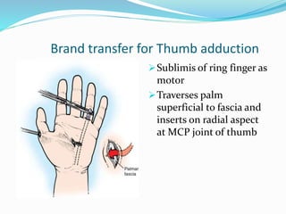 Brand transfer for Thumb adduction
Sublimis of ring finger as
motor
Traverses palm
superficial to fascia and
inserts on radial aspect
at MCP joint of thumb
 