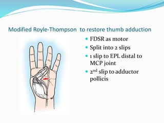 Modified Royle-Thompson to restore thumb adduction
 FDSR as motor
 Split into 2 slips
 1 slip to EPL distal to
MCP joint
 2nd slip to adductor
pollicis
 