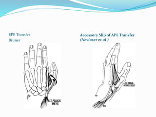 EPB Transfer
Bruner
Accessory Slip of APL Transfer
(Neviaser et al )
 