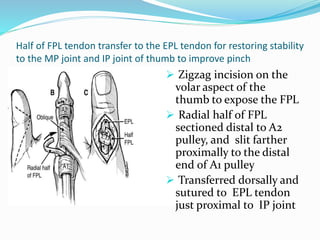 Half of FPL tendon transfer to the EPL tendon for restoring stability
to the MP joint and IP joint of thumb to improve pinch
 Zigzag incision on the
volar aspect of the
thumb to expose the FPL
 Radial half of FPL
sectioned distal to A2
pulley, and slit farther
proximally to the distal
end of A1 pulley
 Transferred dorsally and
sutured to EPL tendon
just proximal to IP joint
 