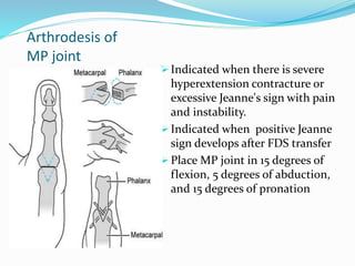 Arthrodesis of
MP joint
 Indicated when there is severe
hyperextension contracture or
excessive Jeanne's sign with pain
and instability.
 Indicated when positive Jeanne
sign develops after FDS transfer
 Place MP joint in 15 degrees of
flexion, 5 degrees of abduction,
and 15 degrees of pronation
 