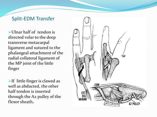 Split-EDM Transfer
Ulnar half of tendon is
directed volar to the deep
transverse metacarpal
ligament and sutured to the
phalangeal attachment of the
radial collateral ligament of
the MP joint of the little
finger
If little finger is clawed as
well as abducted, the other
half tendon is inserted
through the A2 pulley of the
flexor sheath.
 