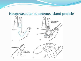 Neurovascular cutaneous island pedicle
 