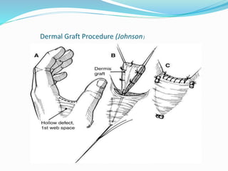 Dermal Graft Procedure (Johnson)
 